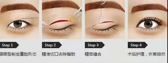 双眼皮3.jpg