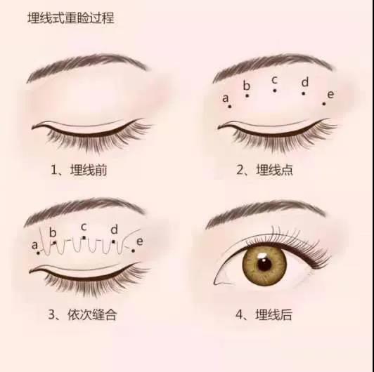 双眼皮4.jpg