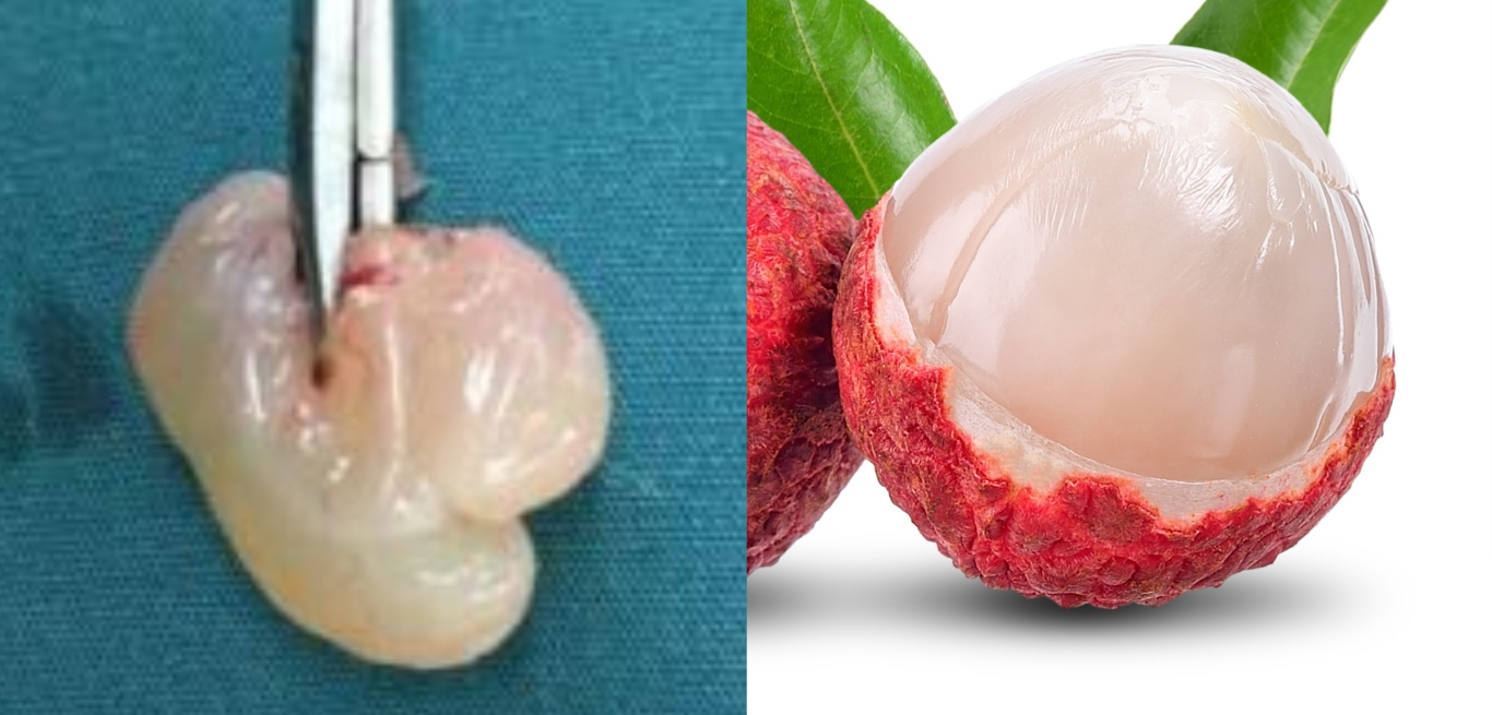 鼻息肉1.png